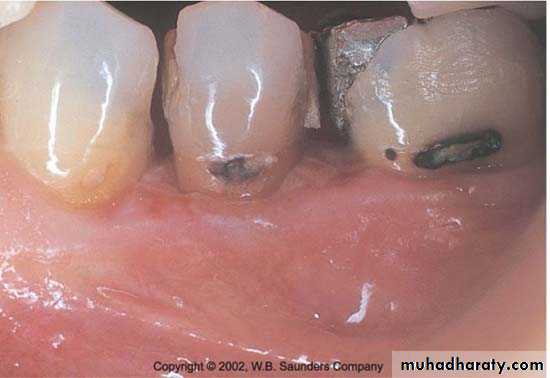 The predisposing factors for periodental diseases