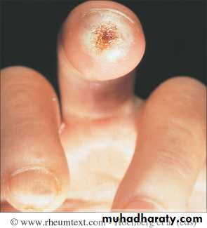 Autoimmune Connective Tissue Diseases-Part 2