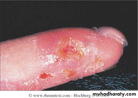 Autoimmune Connective Tissue Diseases-Part 2