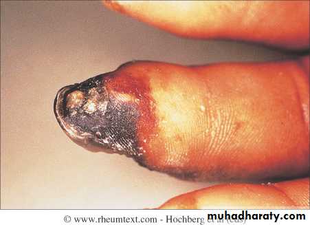 Autoimmune Connective Tissue Diseases-Part 2