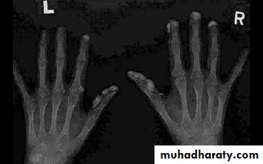 Autoimmune Connective Tissue Diseases-Part 2