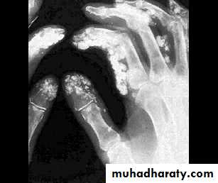 Autoimmune Connective Tissue Diseases-Part 2