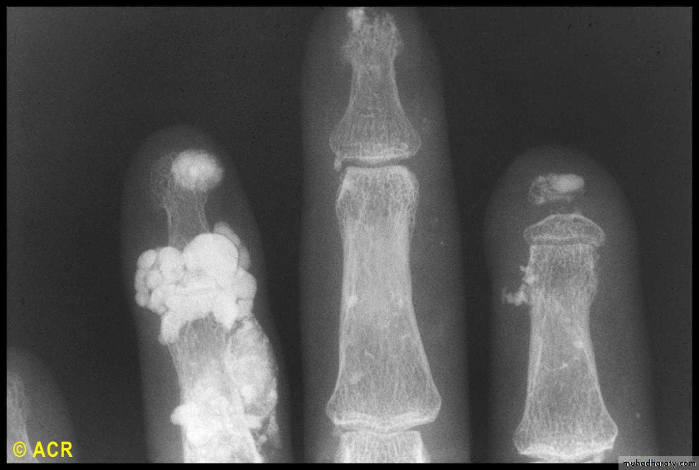 Autoimmune Connective Tissue Diseases-Part 2
