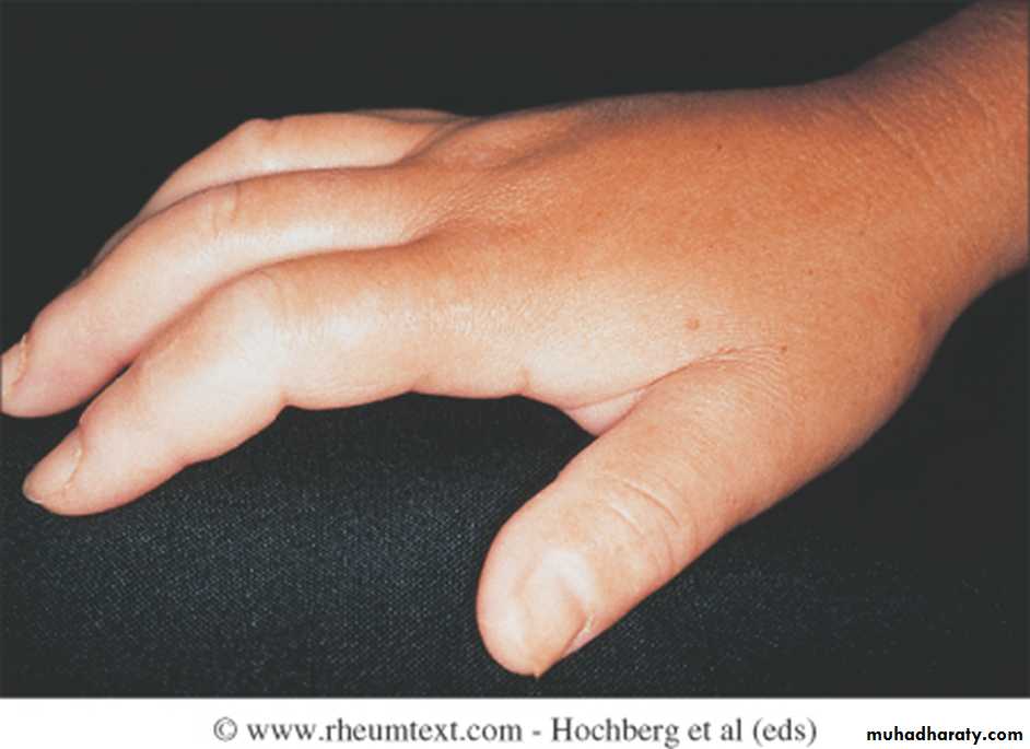 Autoimmune Connective Tissue Diseases-Part 2