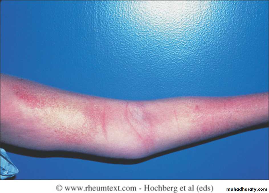 Autoimmune Connective Tissue Diseases-Part 2