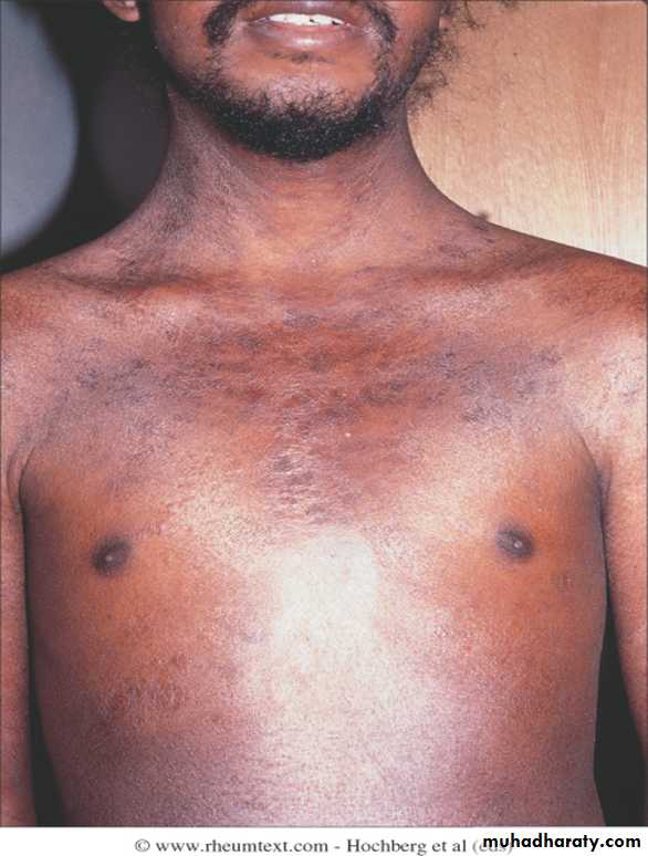 Autoimmune Connective Tissue Diseases-Part 2