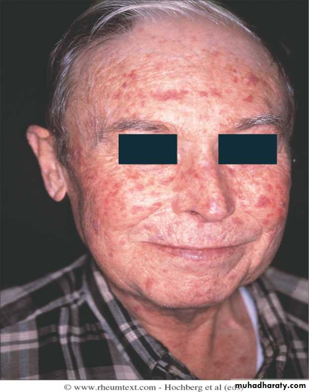 Autoimmune Connective Tissue Diseases-Part 2
