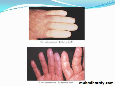 Autoimmune Connective Tissue Diseases-Part 2