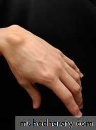 Trigger finger