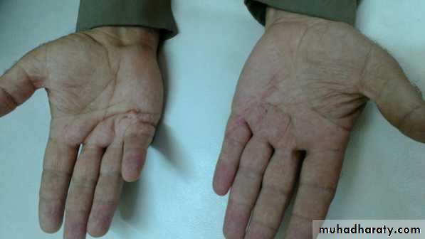 Trigger finger