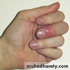 Trigger finger