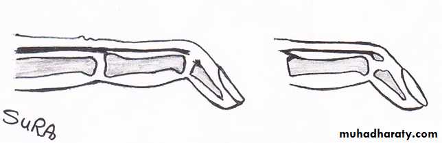 Trigger finger