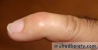 Trigger finger