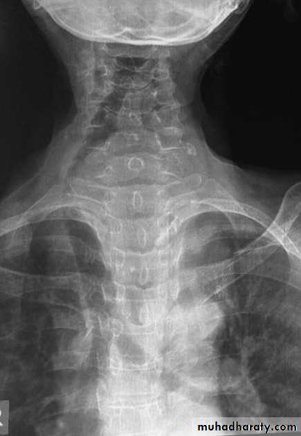 Mediastinum الاولى والثانية