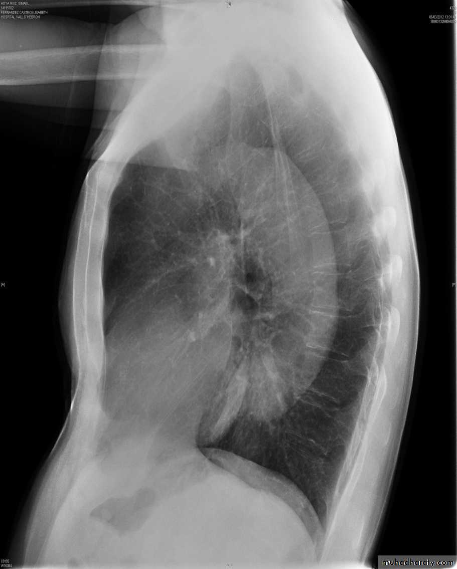 Mediastinum الاولى والثانية