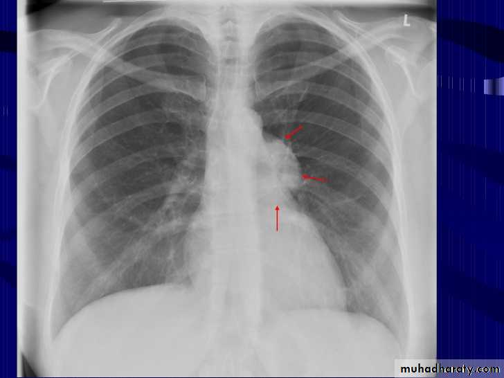 Mediastinum الاولى والثانية