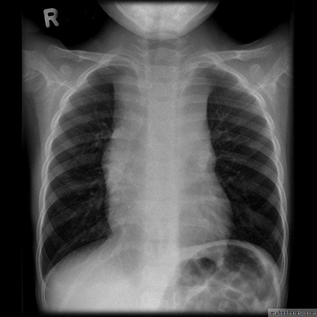 Mediastinum الاولى والثانية