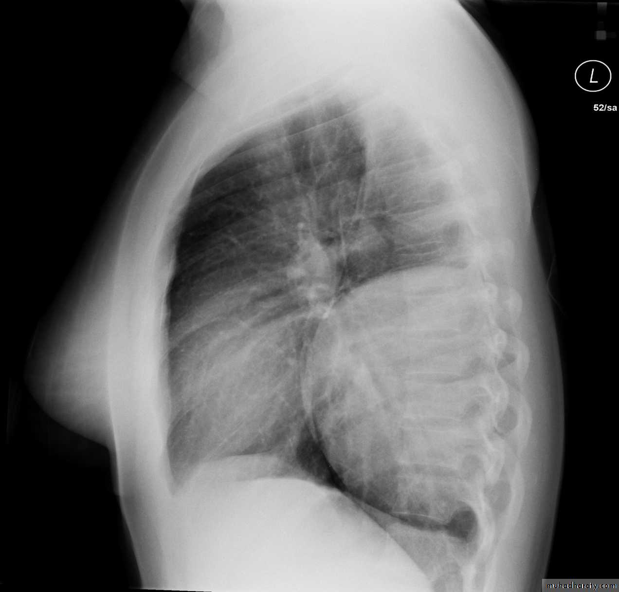 Mediastinum الاولى والثانية