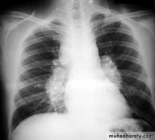 Mediastinum الاولى والثانية