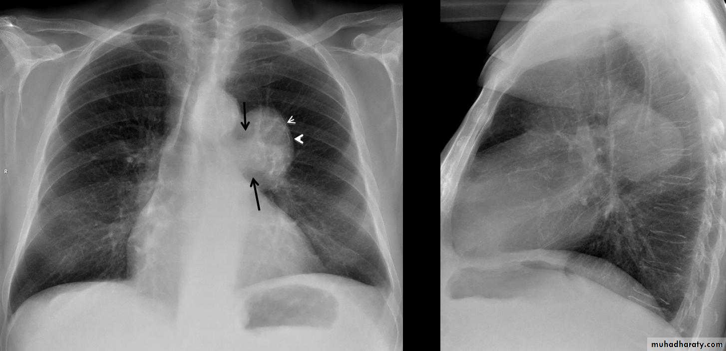 Mediastinum الاولى والثانية
