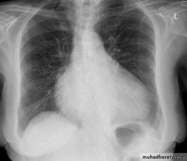 Mediastinum الاولى والثانية