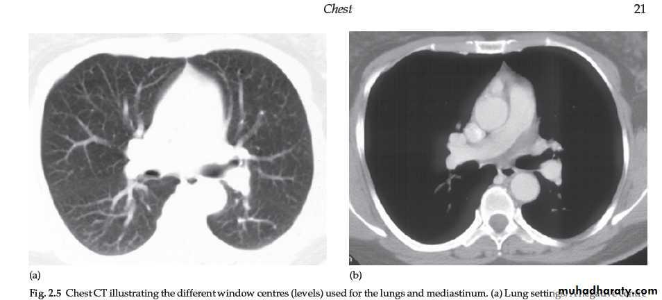 Mediastinum الاولى والثانية