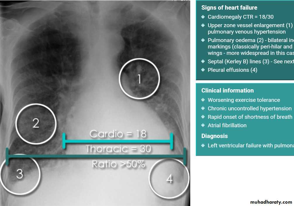 Mediastinum الاولى والثانية