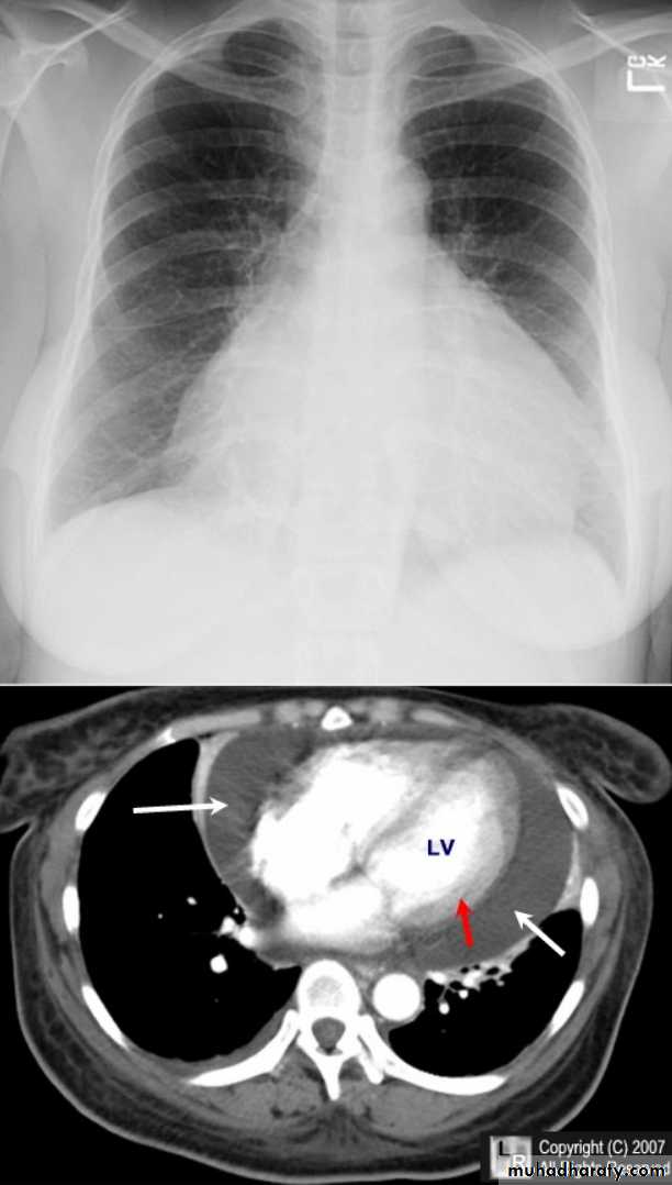 Mediastinum الاولى والثانية