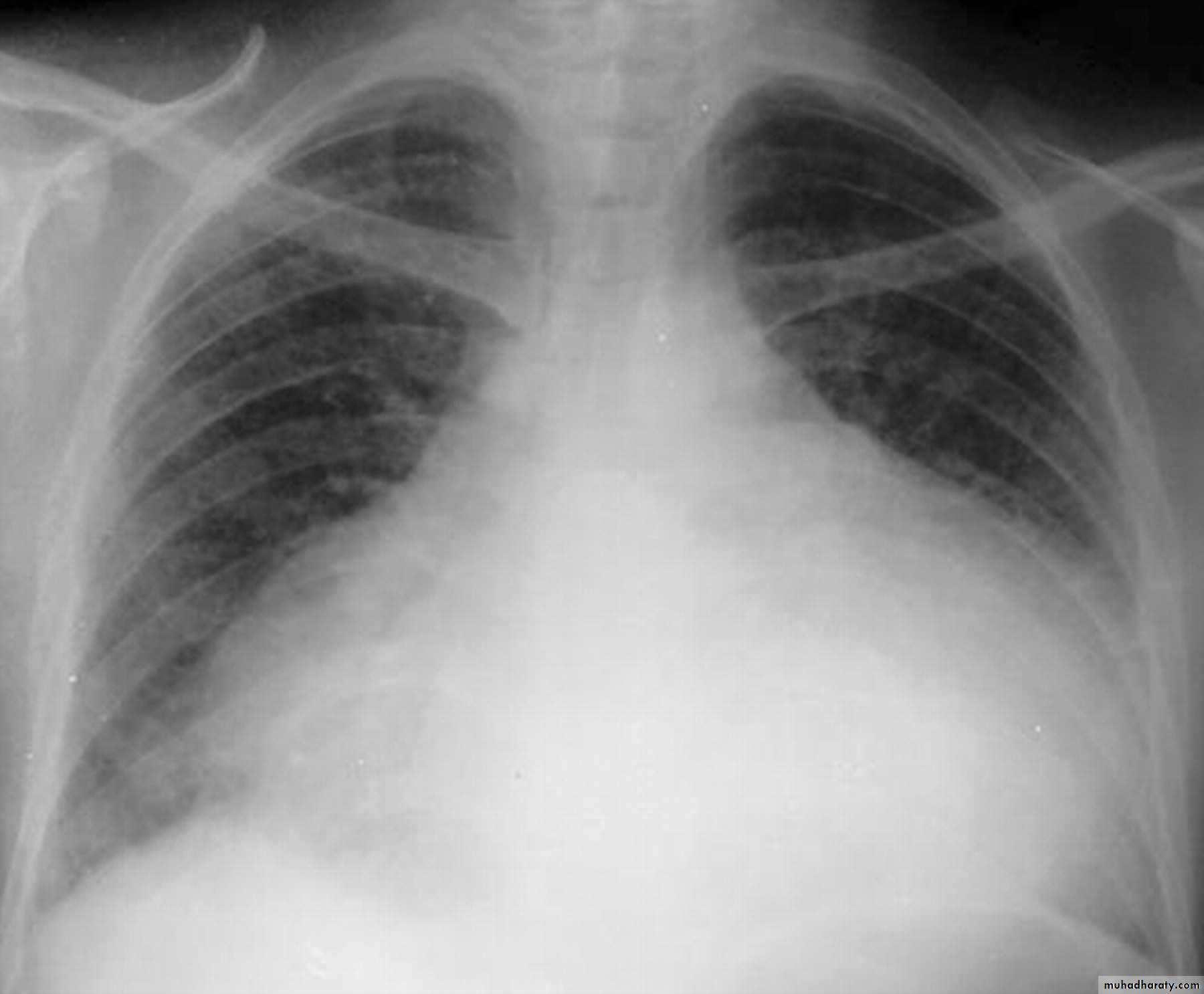 Mediastinum الاولى والثانية
