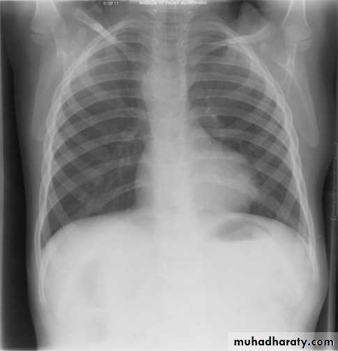 Mediastinum الاولى والثانية