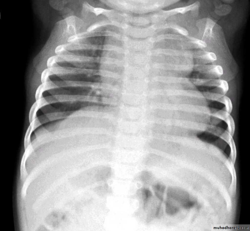 Mediastinum الاولى والثانية