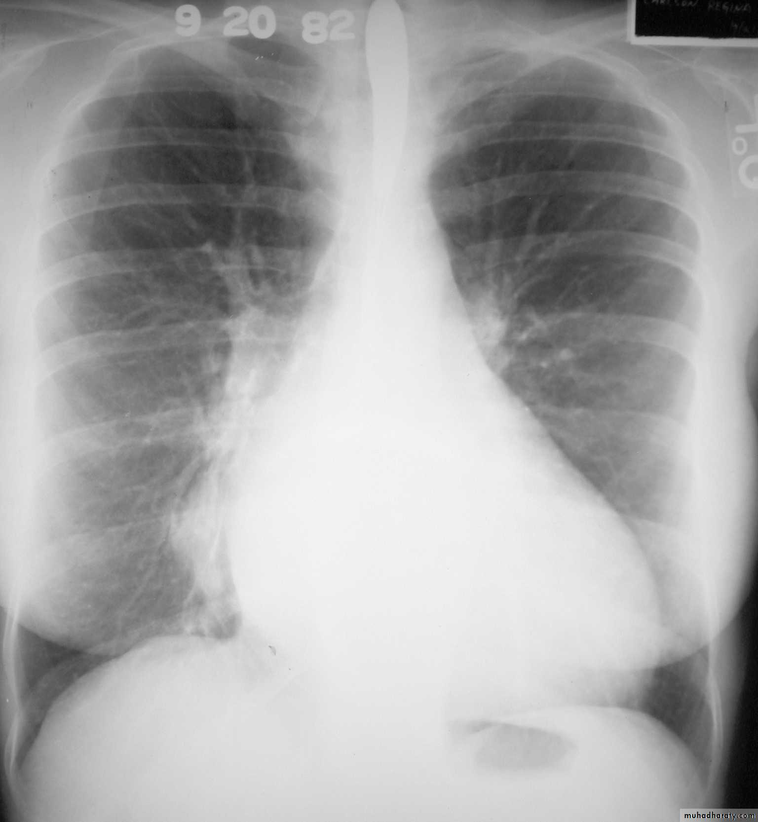 Mediastinum الاولى والثانية