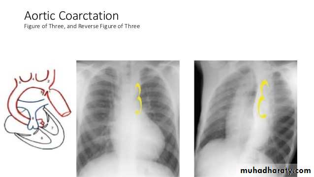 Mediastinum الاولى والثانية