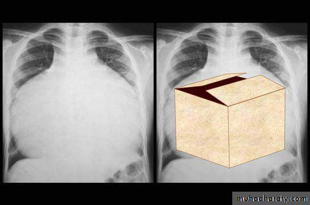 Mediastinum الاولى والثانية