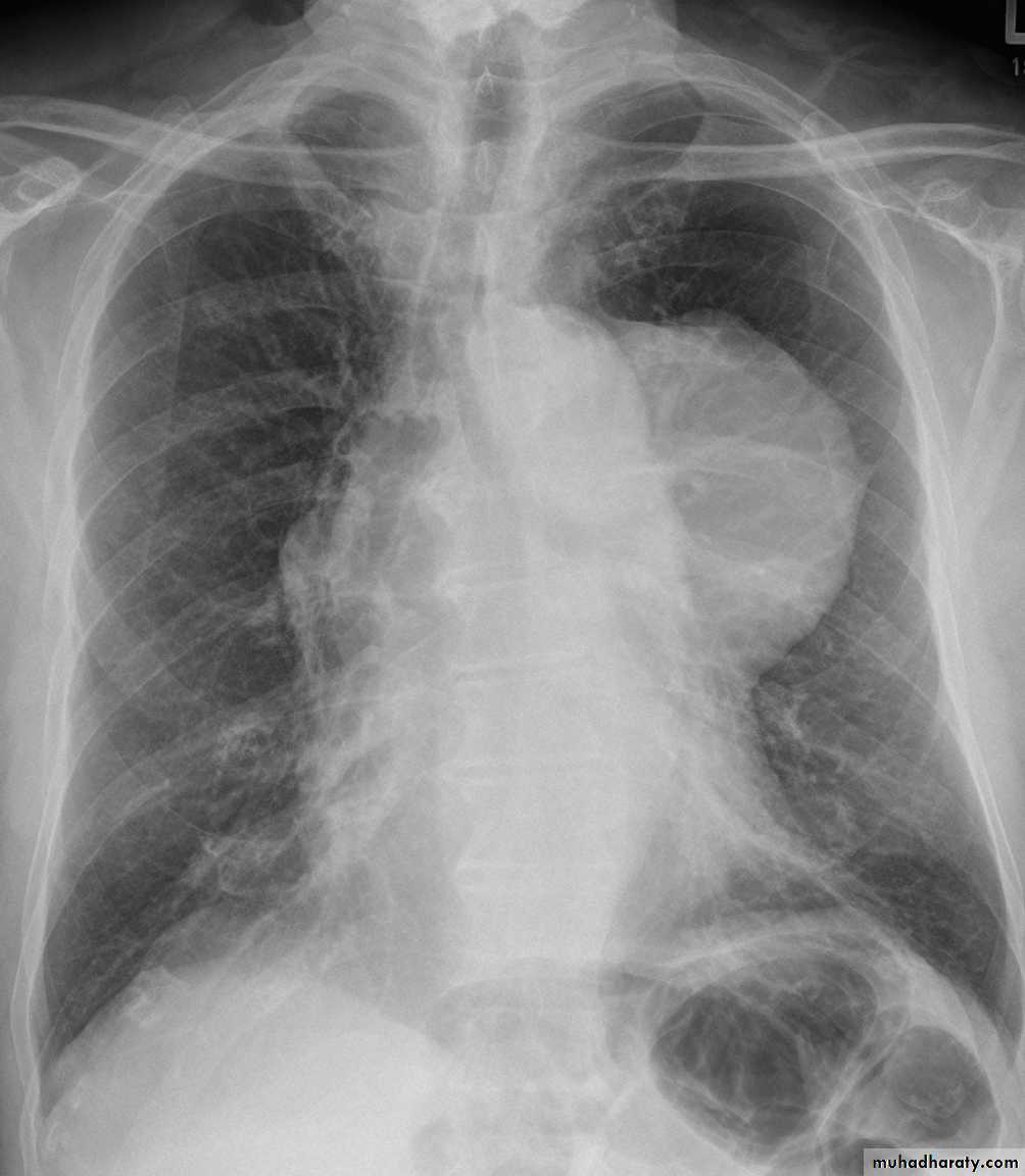 Mediastinum الاولى والثانية