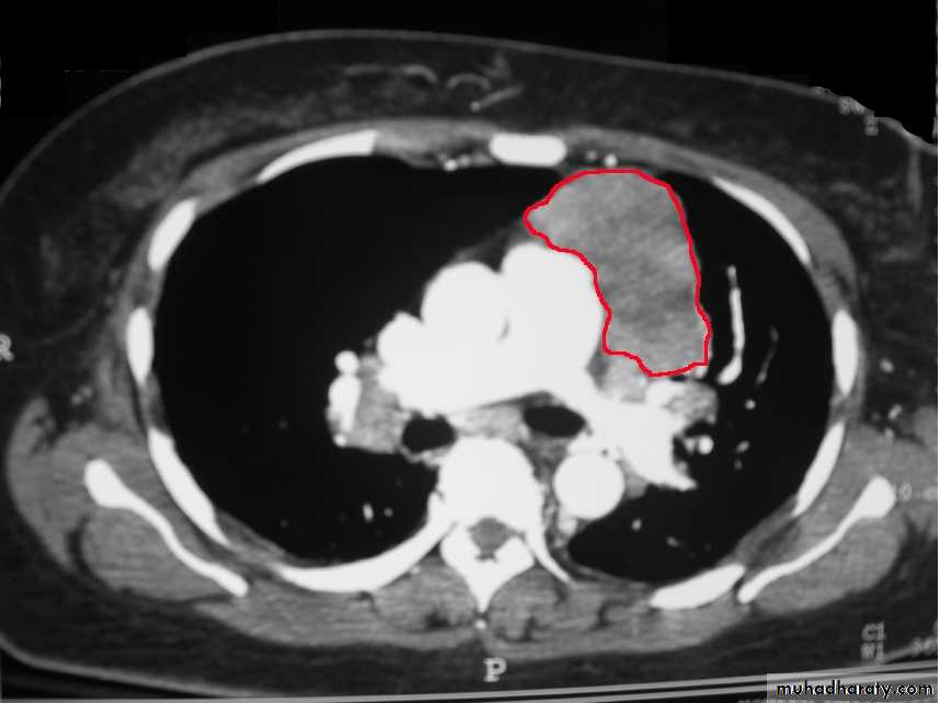 Mediastinum الاولى والثانية