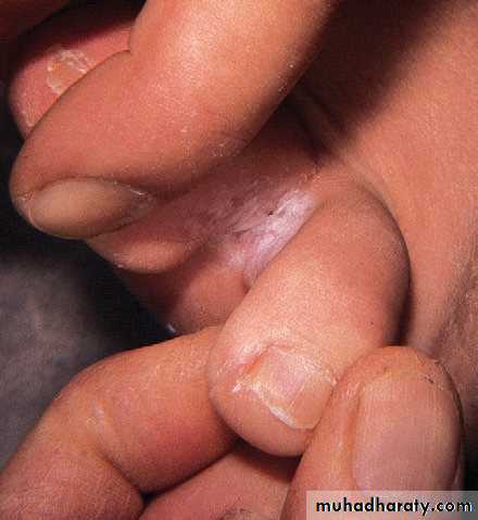 FUNGAL INFECTION 2