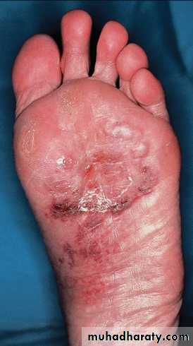 FUNGAL INFECTION 2