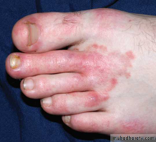 FUNGAL INFECTION 2
