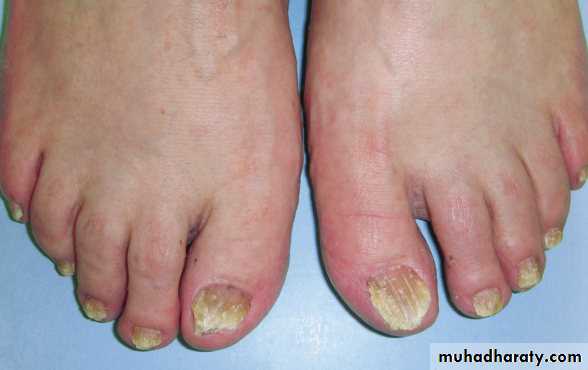 FUNGAL INFECTION 2