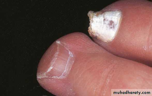 FUNGAL INFECTION 2