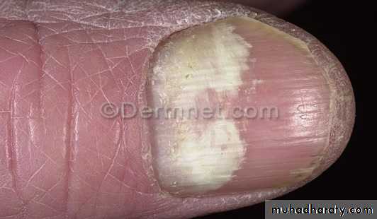 FUNGAL INFECTION 2