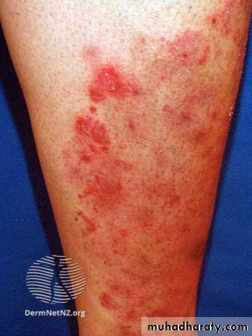 FUNGAL INFECTION 2