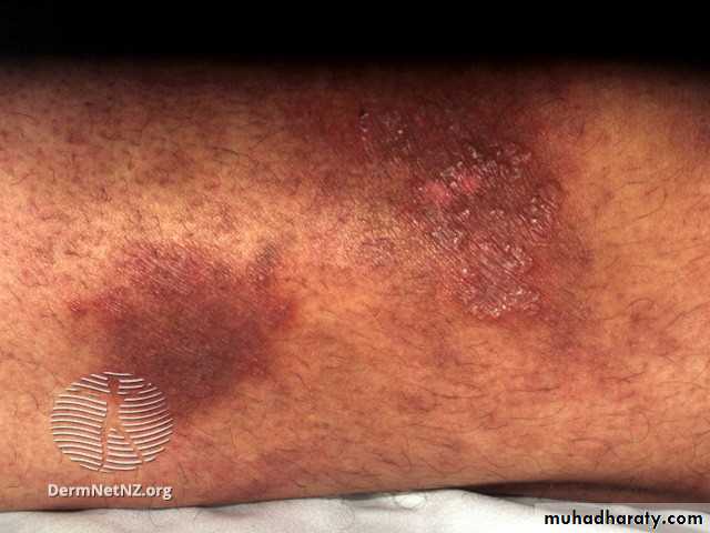 FUNGAL INFECTION 2