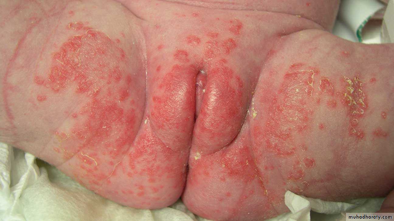 FUNGAL INFECTION 2