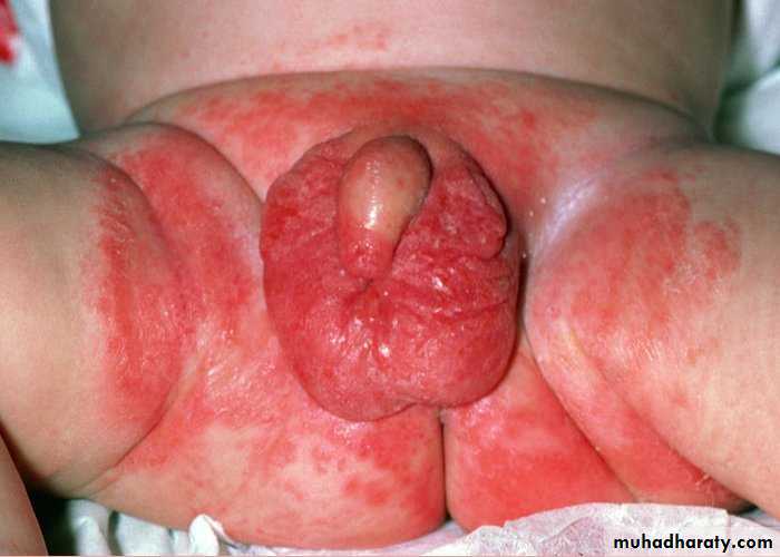 FUNGAL INFECTION 2
