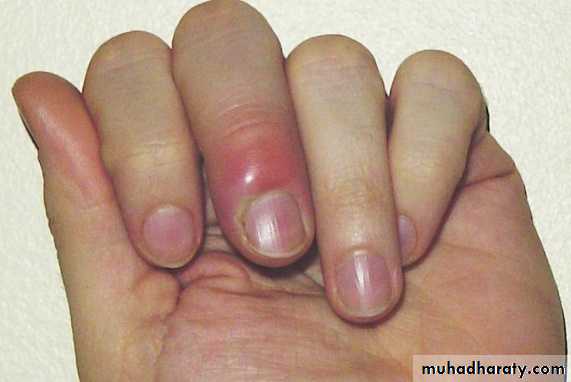 FUNGAL INFECTION 2