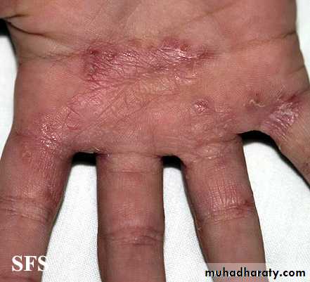 FUNGAL INFECTION 2