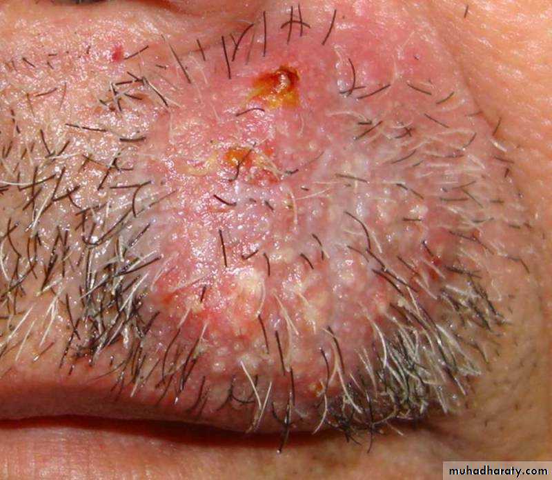 FUNGAL INFECTION 2