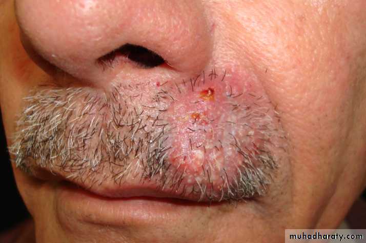 FUNGAL INFECTION 2